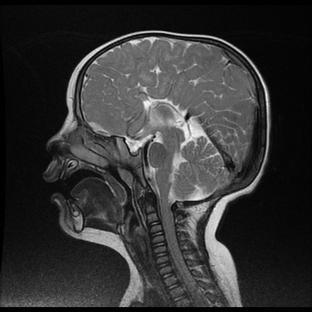 Corpus Callosum Agenesis Radiology Case Radiopaedia Org