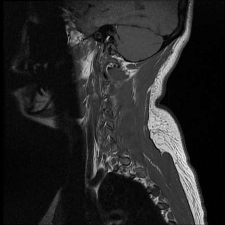 Fenestration of the right vertebral artery V3 segment | Radiology Case ...