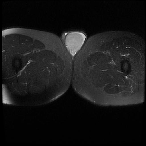 Testicular Seminoma Image