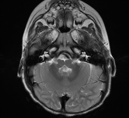 Horizontal Gaze Paralysis With Progressive Scoliosis | Image ...