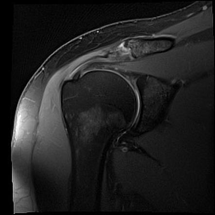 SLAP tear | Image | Radiopaedia.org