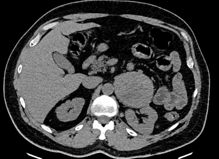 Adrenal metastases | Image | Radiopaedia.org