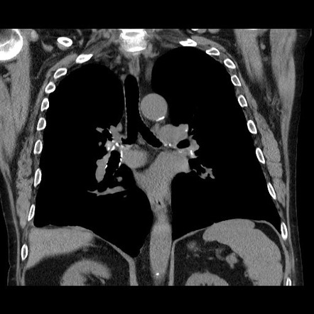 Bronchial stenosis - lung transplant | Image | Radiopaedia.org