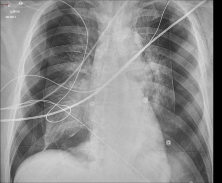 Pneumothorax | Radiology Reference Article | Radiopaedia.org