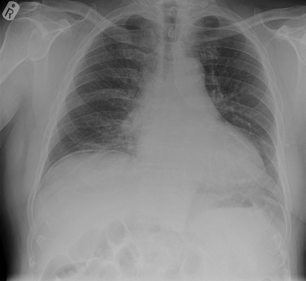 Pneumoperitoneum (tiny) | Radiology Case | Radiopaedia.org