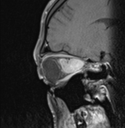 Optic nerve glioma | Radiology Case | Radiopaedia.org