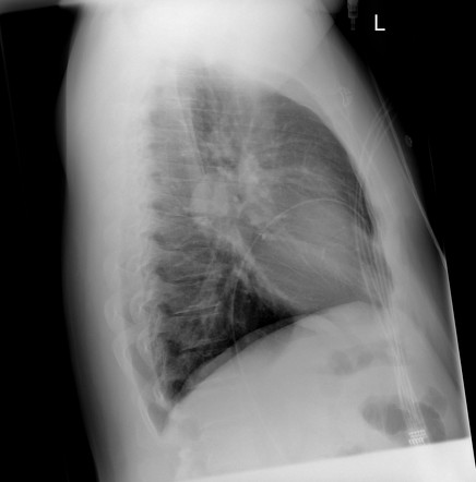 Bronchogenic cyst - mediastinal | Image | Radiopaedia.org