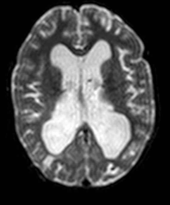 Diffuse leptomeningeal glioneuronal tumor | Image | Radiopaedia.org