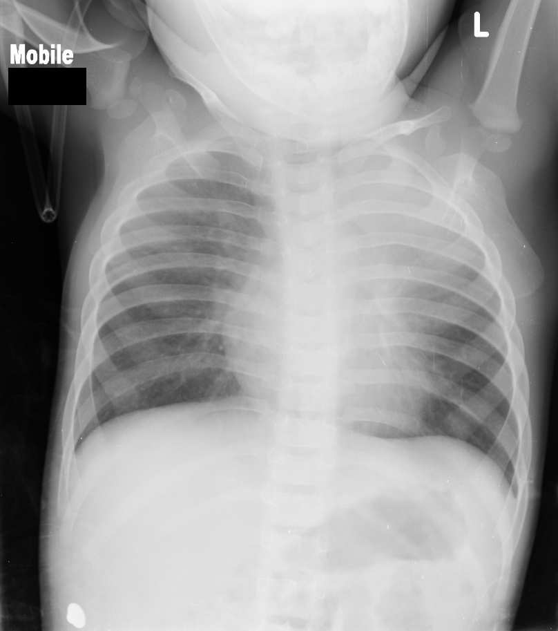 Left upper lobe atelectasis with luftsichel sign | Image | Radiopaedia.org