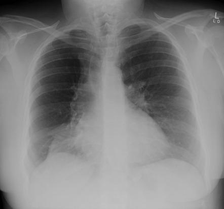 Right middle lobe collapse | Radiology Reference Article | Radiopaedia.org