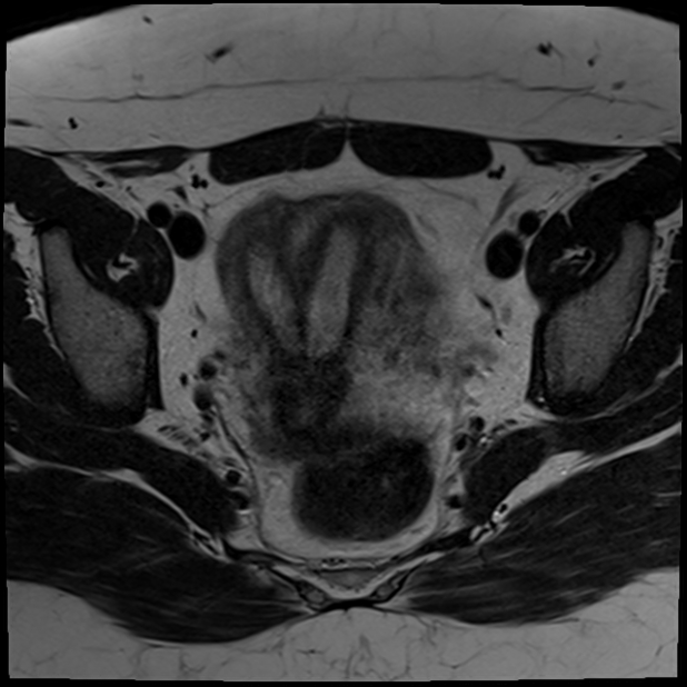 Septate uterus | Image | Radiopaedia.org