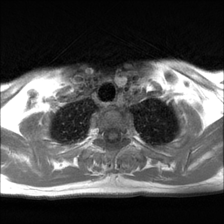 Parathyroid adenoma | Image | Radiopaedia.org