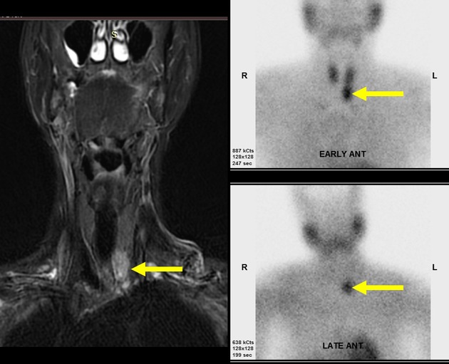 Parathyroid Adenoma Radiology Reference Article