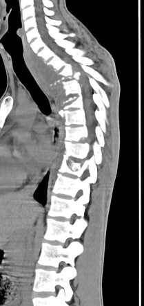 Severe Pott disease of the thoracic spine | Radiology Case ...