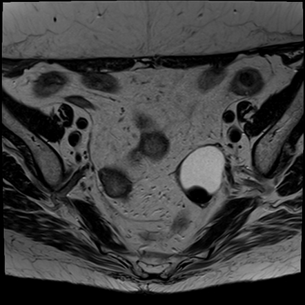 Ovarian serous cystadenofibroma | Radiology Case | Radiopaedia.org