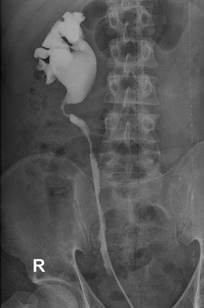 Retrograde Pyelography Radiology Reference Article Radiopaedia Org