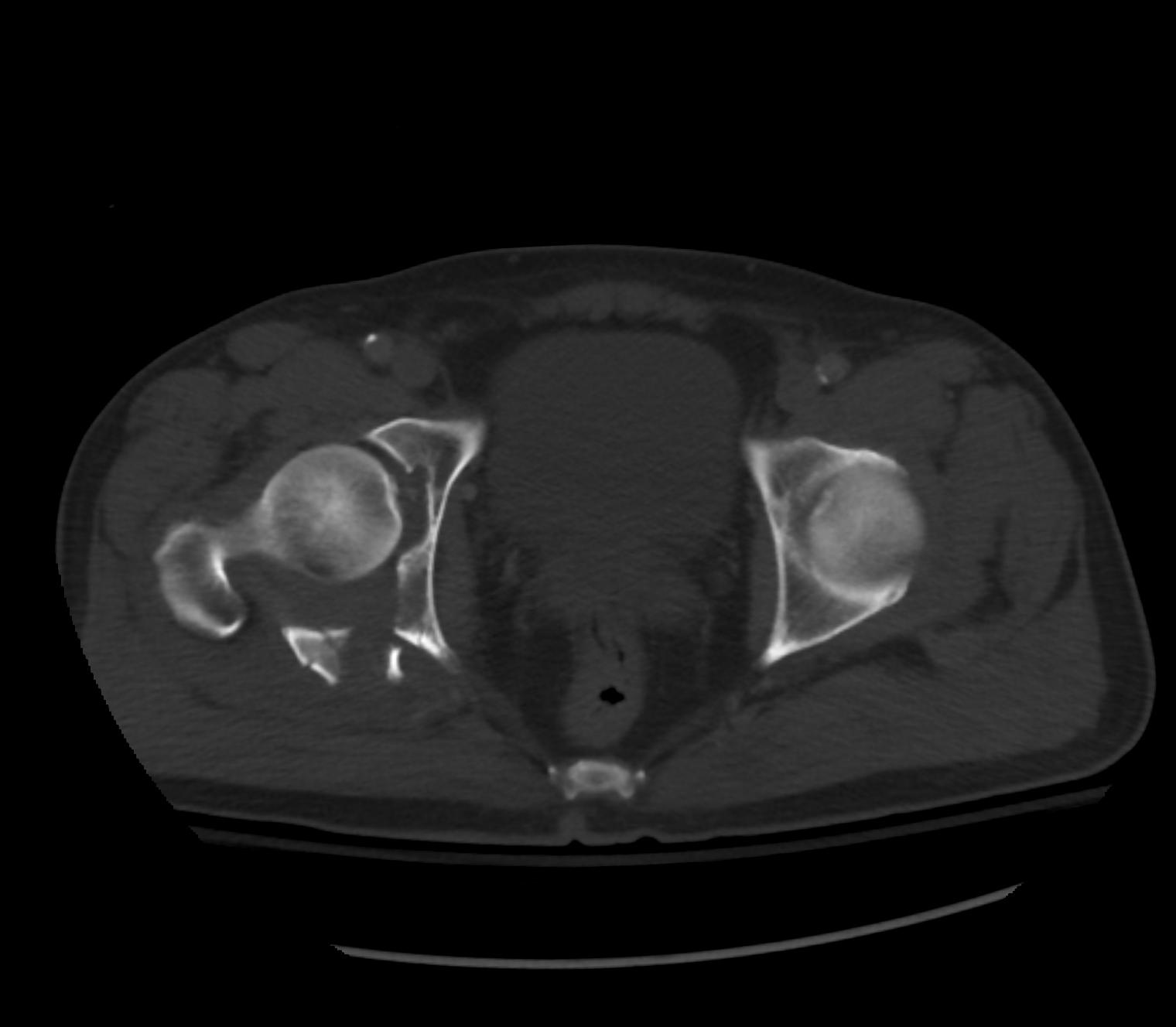 Posterior Wall Acetabular Fracture Image