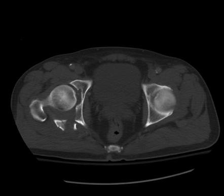 Posterior wall acetabular fracture | Image | Radiopaedia.org