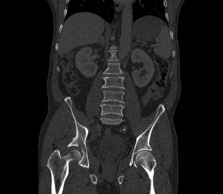 Posterior wall acetabular fracture | Image | Radiopaedia.org