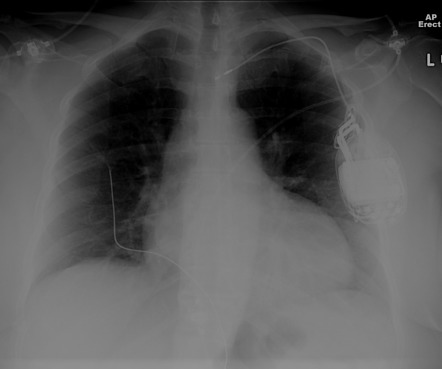 Twiddler syndrome | Radiology Reference Article | Radiopaedia.org