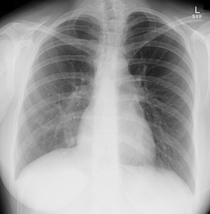 Scimitar syndrome (lungs) | Radiology Reference Article | Radiopaedia.org