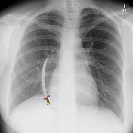 Scimitar syndrome (lungs) | Radiology Reference Article | Radiopaedia.org