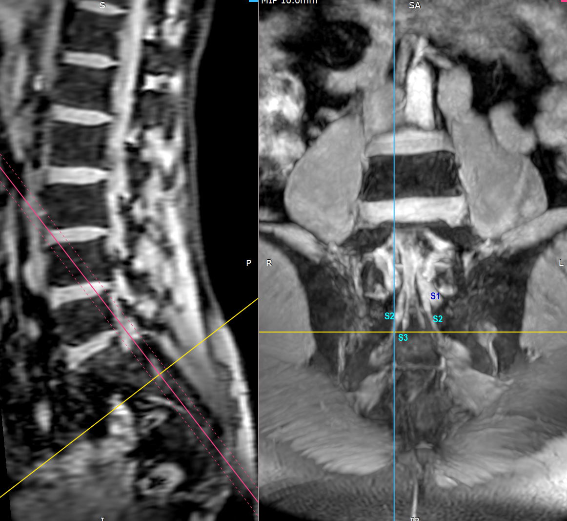 Bilateral conjoined nerve roots at different levels | Image ...