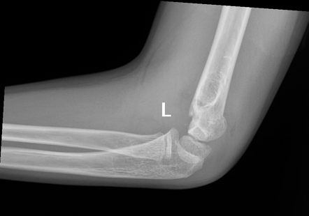 Posterior fat pad sign (elbow) | Radiology Reference Article ...