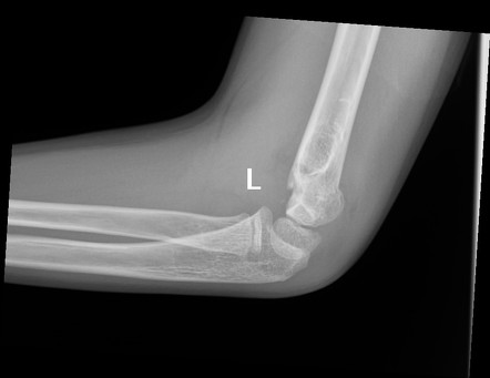 Supracondylar Fracture Fat Pad Sign