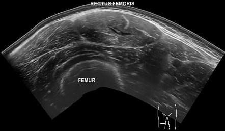 Rectus Femoris Strain Symptoms