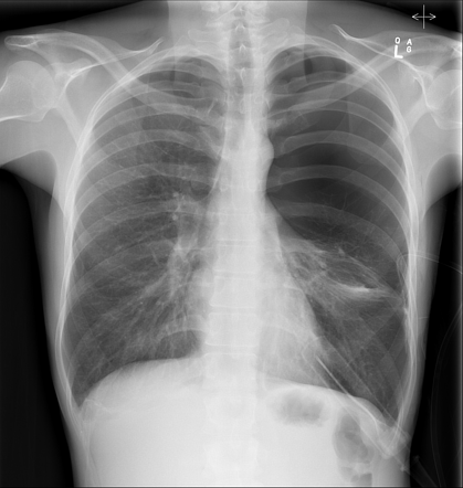 Pneumothorax | Radiology Reference Article | Radiopaedia.org