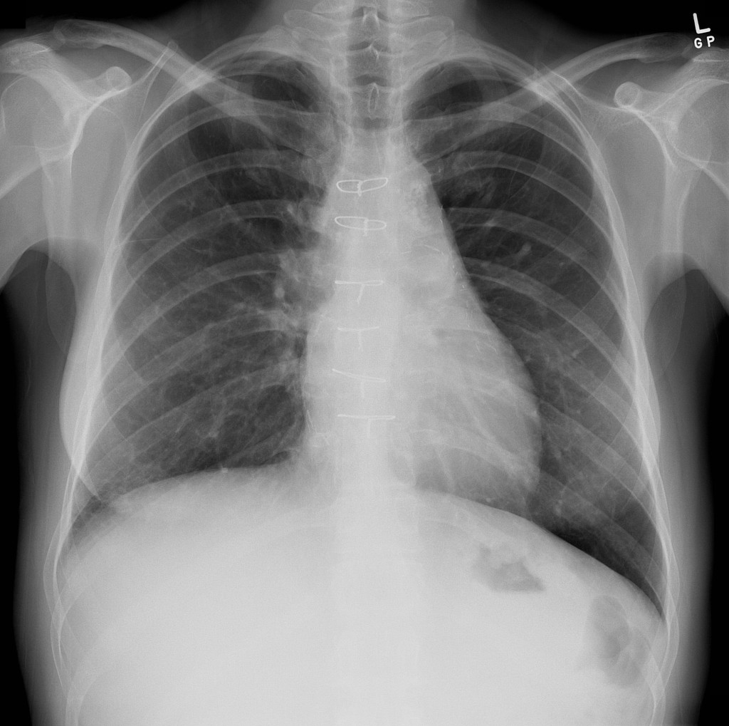 Radiation Therapy Neck Lymph Nodes All About Radiation