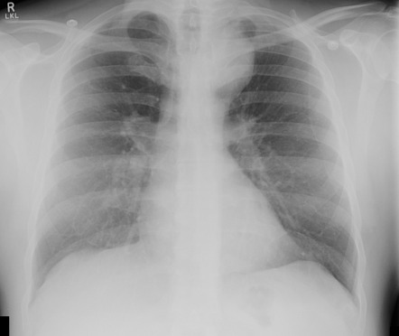 Superior mediastinal mass due to esophageal duplication cyst ...