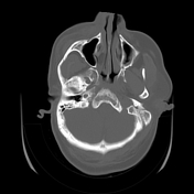 Zygomaticomaxillary Complex Fracture Radiology Reference Article