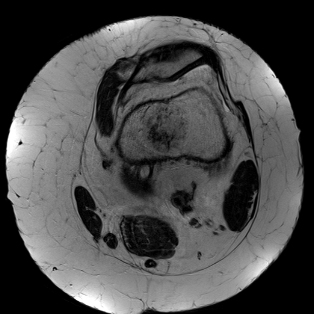 Enchondroma - distal femur | Image | Radiopaedia.org