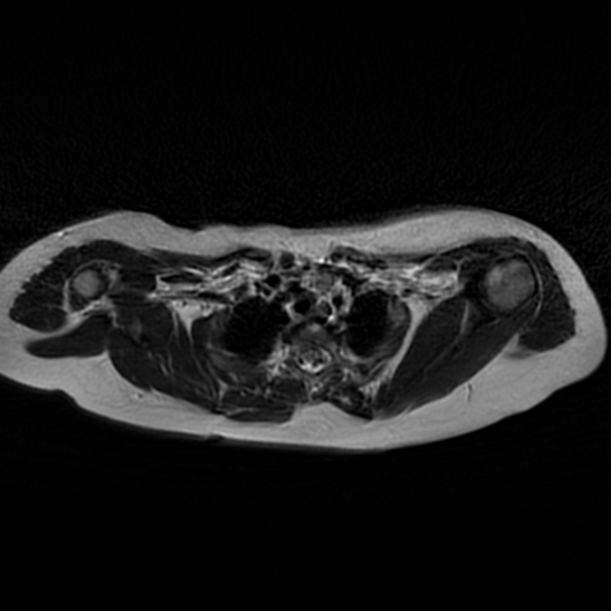 Bilateral Sprengel Deformity With Klippel-Feil Syndrome | Image ...