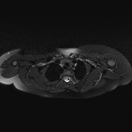 Bilateral Sprengel Deformity With Klippel-Feil Syndrome | Image ...