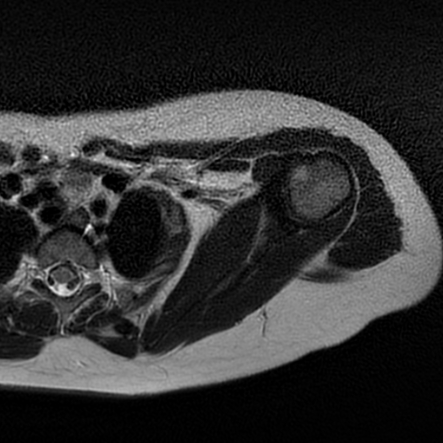 Bilateral Sprengel Deformity With Klippel-Feil Syndrome | Image ...