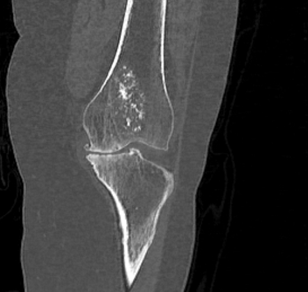 Enchondroma - distal femur | Image | Radiopaedia.org