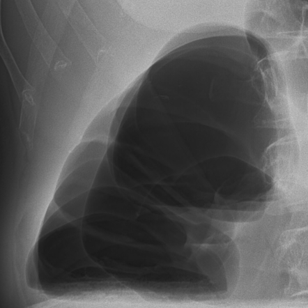 Pseudopneumoperitoneum | Radiology Reference Article | Radiopaedia.org