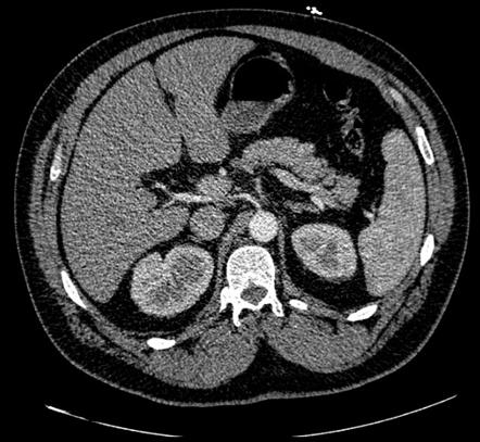 Variant Hepatic Arterial Anatomy | Radiology Reference Article ...