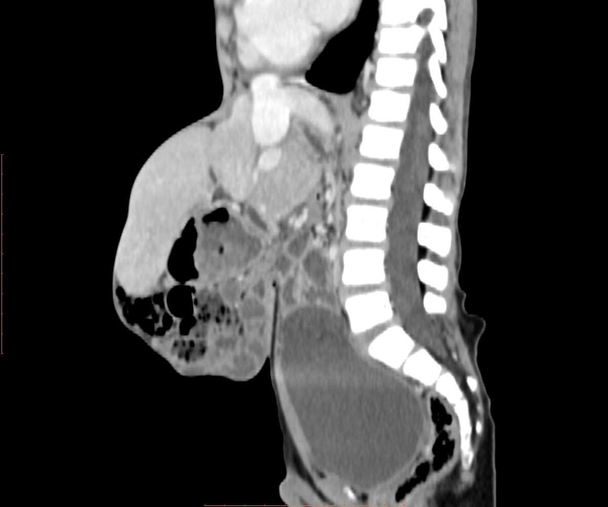 Omphalocele | Image | Radiopaedia.org