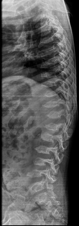 Morquio syndrome | Radiology Reference Article | Radiopaedia.org