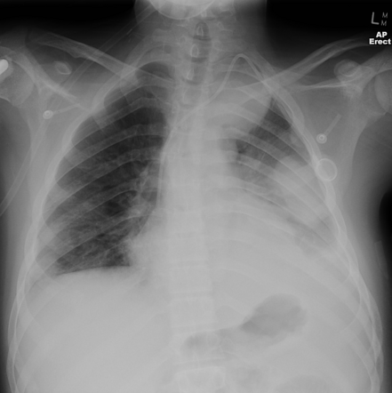 Pulmonary Metastases 