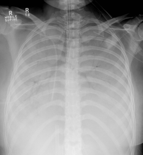 Hemithorax white-out (differential)