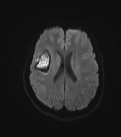 Hyperacute intraparenchymal hemorrhage | Image | Radiopaedia.org