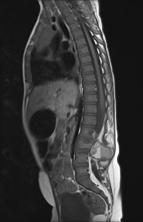 Spine aneurysmal bone cyst | Image | Radiopaedia.org