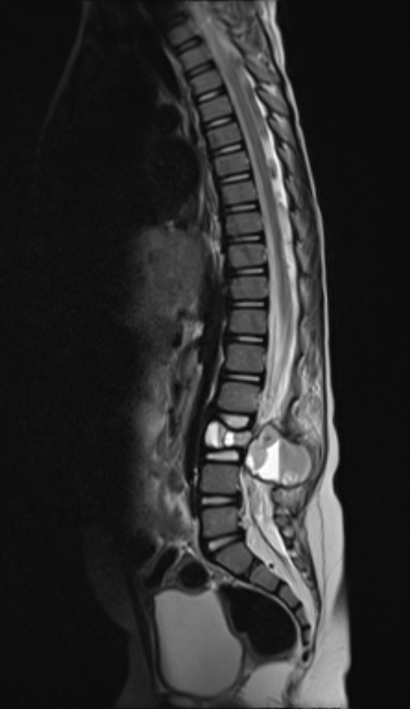 Spine Aneurysmal Bone Cyst Image