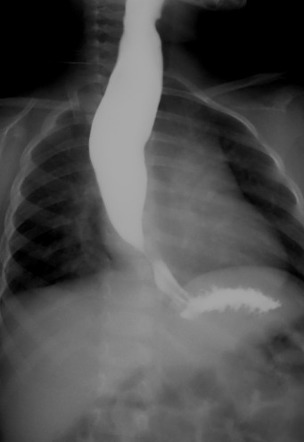 Achalasia | Radiology Case | Radiopaedia.org