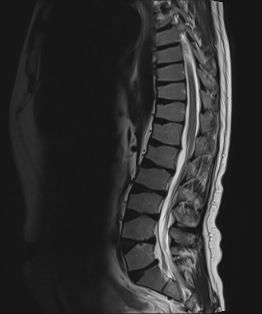 Lumbar Scheuermann disease | Image | Radiopaedia.org